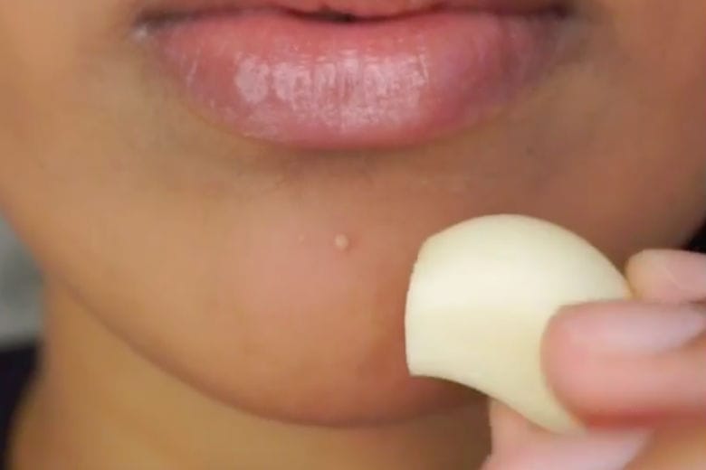 garlic-pimples